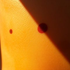 Przebarwienia posłoneczne: przyczyny, profilaktyka i leczenie